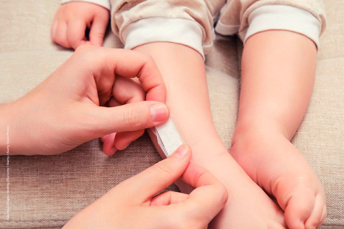 Dellwarzen den Garaus machen