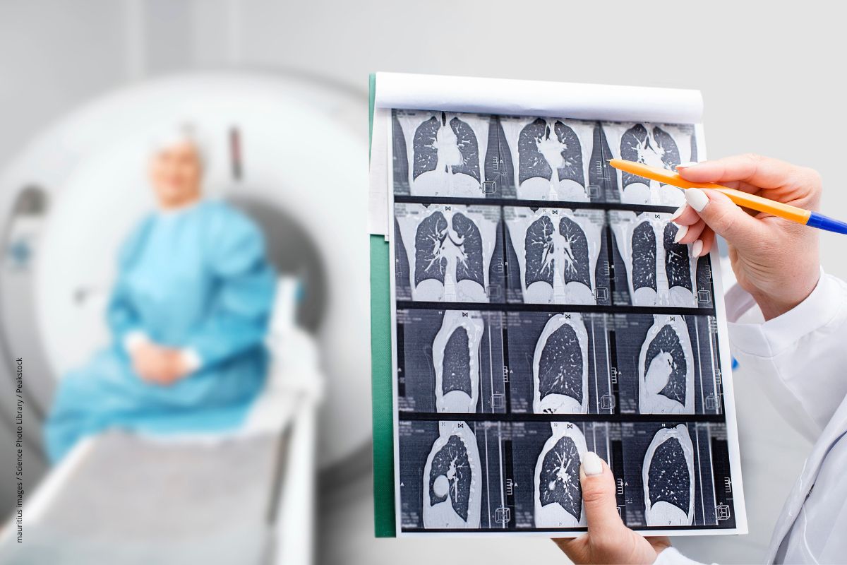 Lungenkrebsscreening für Rauchende