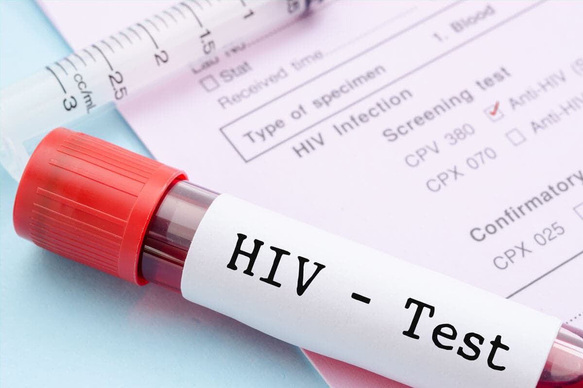 Wann zum HIV-Test?